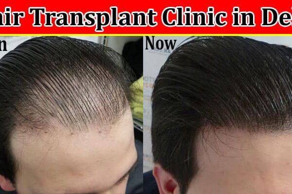 Complete Information About How to Choose the Best Hair Transplant Clinic in Delhi