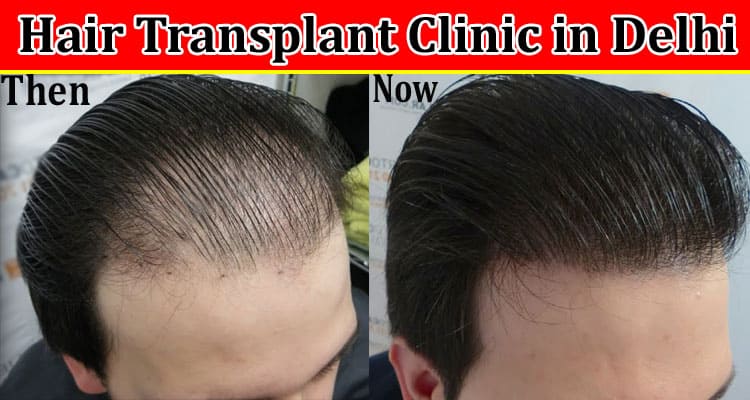 Complete Information About How to Choose the Best Hair Transplant Clinic in Delhi